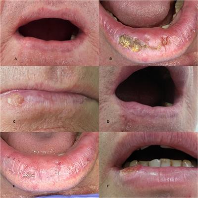 Actinic Cheilitis — From Risk Factors to Therapy